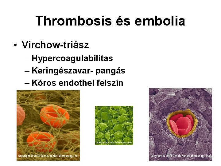 Thrombosis és embolia • Virchow-triász – Hypercoagulabilitas – Keringészavar- pangás – Kóros endothel felszín