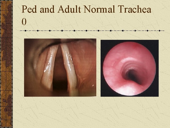 Ped and Adult Normal Trachea 0 
