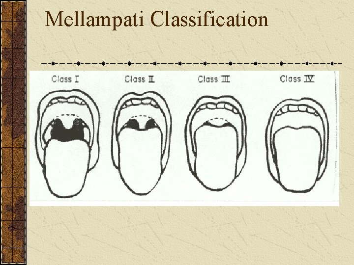 Mellampati Classification 