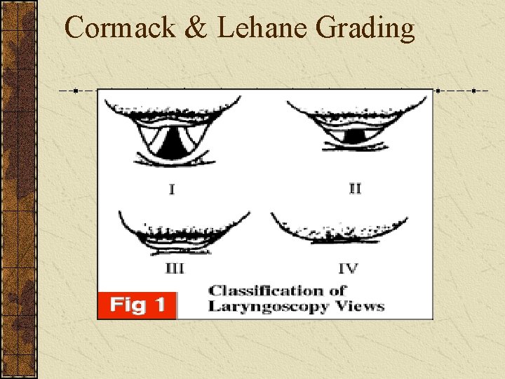 Cormack & Lehane Grading 