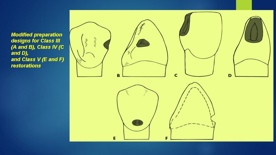 Modified preparation designs for Class III (A and B), Class IV (C and D),