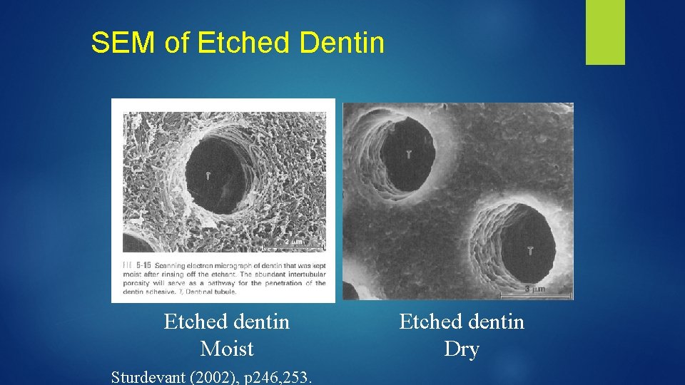 SEM of Etched Dentin Etched dentin Moist Sturdevant (2002), p 246, 253. Etched dentin