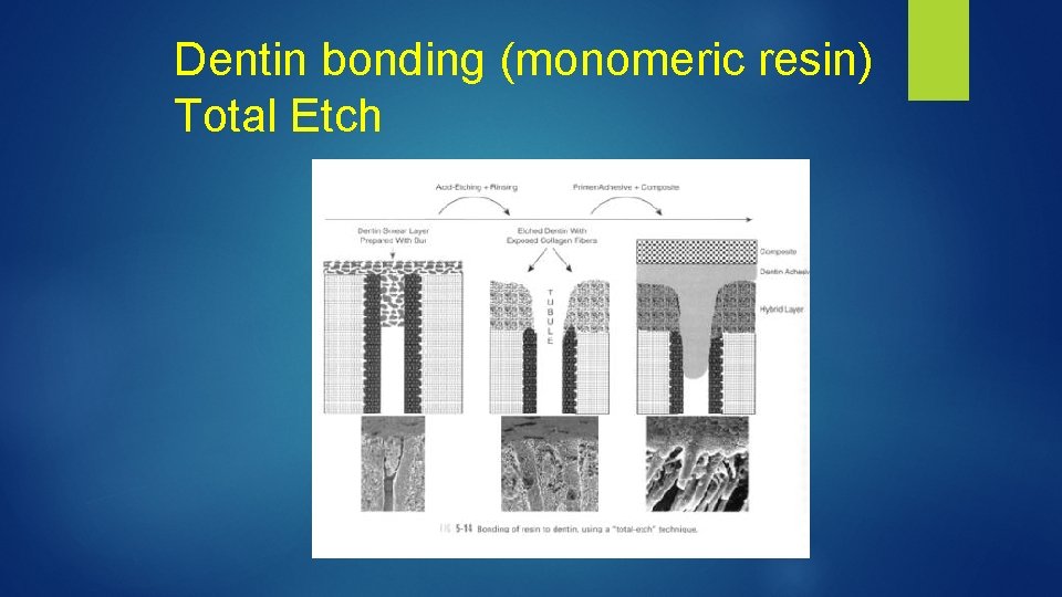 Dentin bonding (monomeric resin) Total Etch 