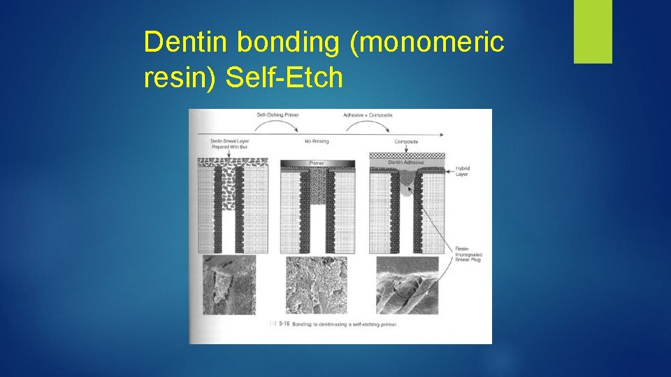 Dentin bonding (monomeric resin) Self-Etch 