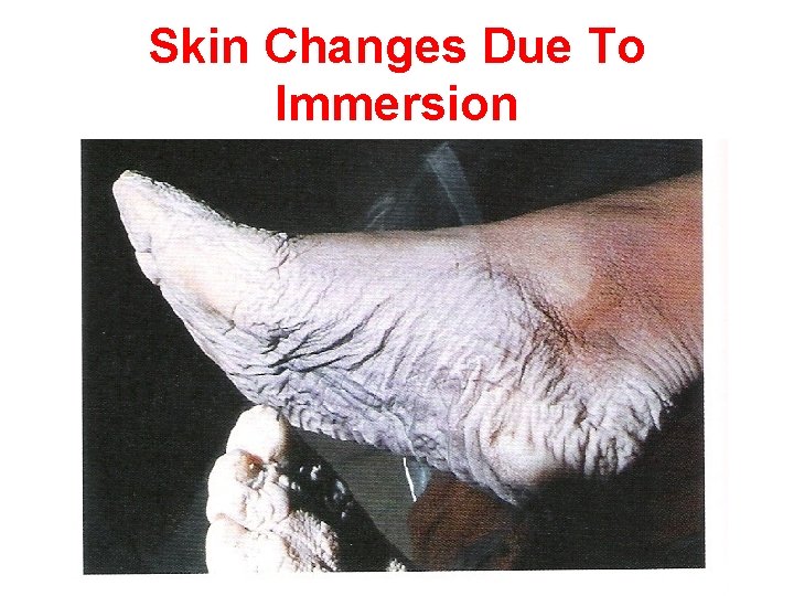 Skin Changes Due To Immersion 
