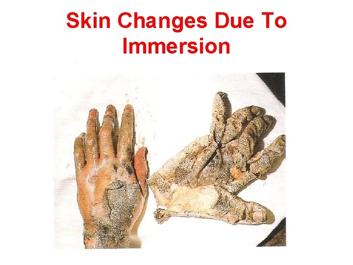 Skin Changes Due To Immersion 