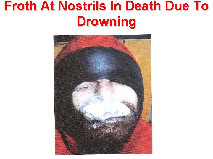 Froth At Nostrils In Death Due To Drowning 
