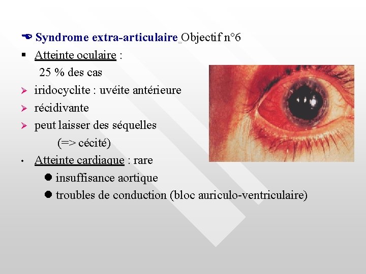  Syndrome extra-articulaire Objectif n° 6 Atteinte oculaire : 25 % des cas Ø