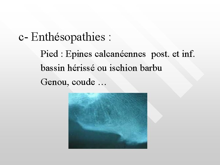 c- Enthésopathies : Pied : Epines calcanéennes post. et inf. bassin hérissé ou ischion