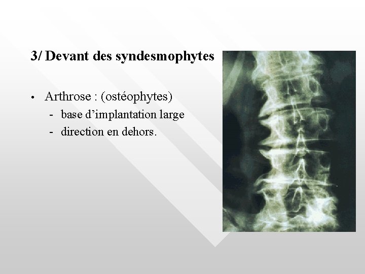 3/ Devant des syndesmophytes • Arthrose : (ostéophytes) - base d’implantation large - direction