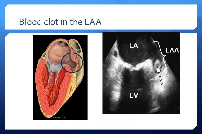 Blood clot in the LAA 