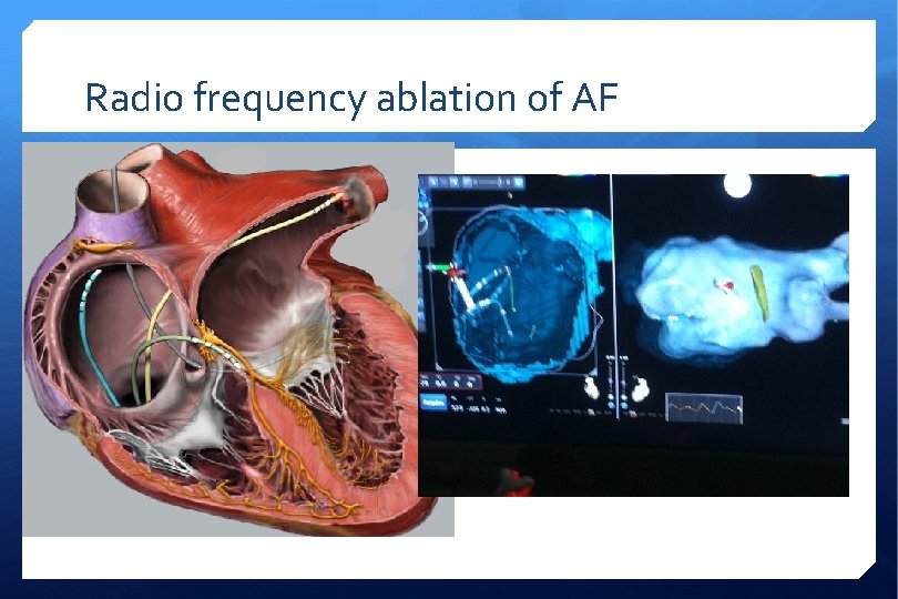 Radio frequency ablation of AF 