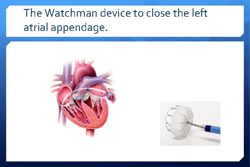 The Watchman device to close the left atrial appendage. 
