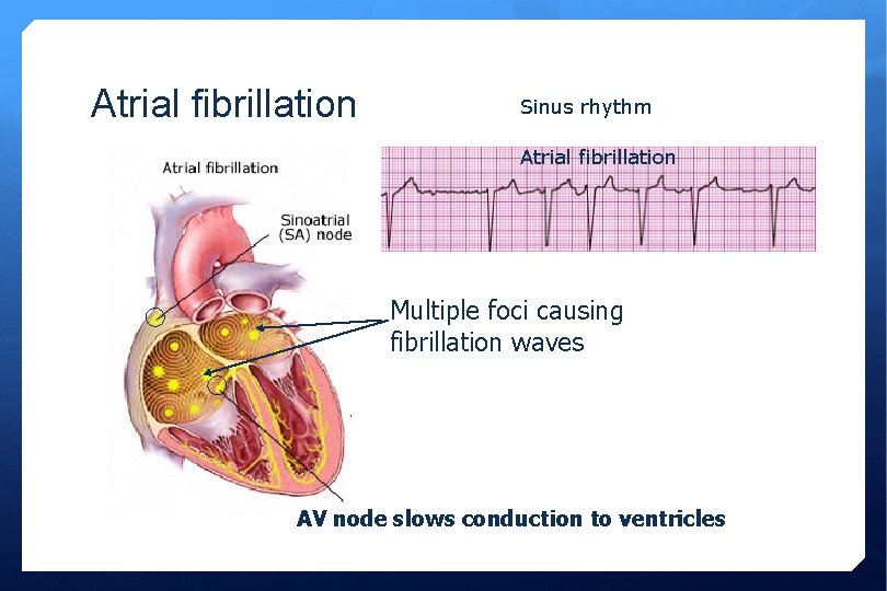 Atrial fibrillation Sinus rhythm Atrial fibrillation Multiple foci causing fibrillation waves AV node slows