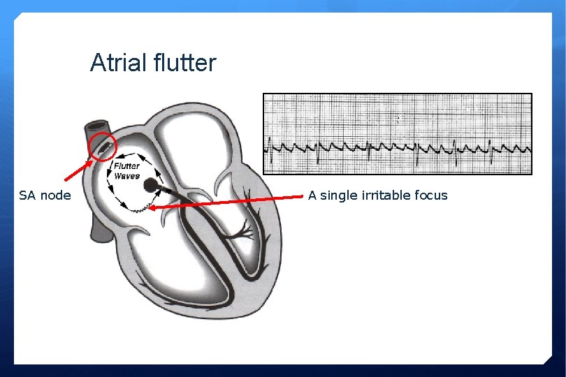 Atrial flutter SA node A single irritable focus 