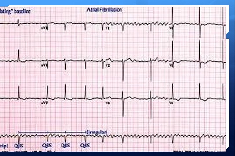 ECG 