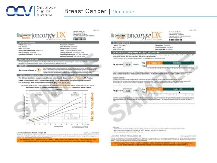 Breast Cancer | Oncotype 