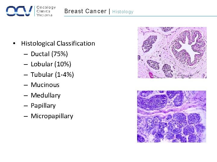 Breast Cancer | • Histological Classification – Ductal (75%) – Lobular (10%) – Tubular