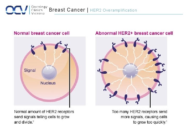 Breast Cancer | HER 2 Overamplification 