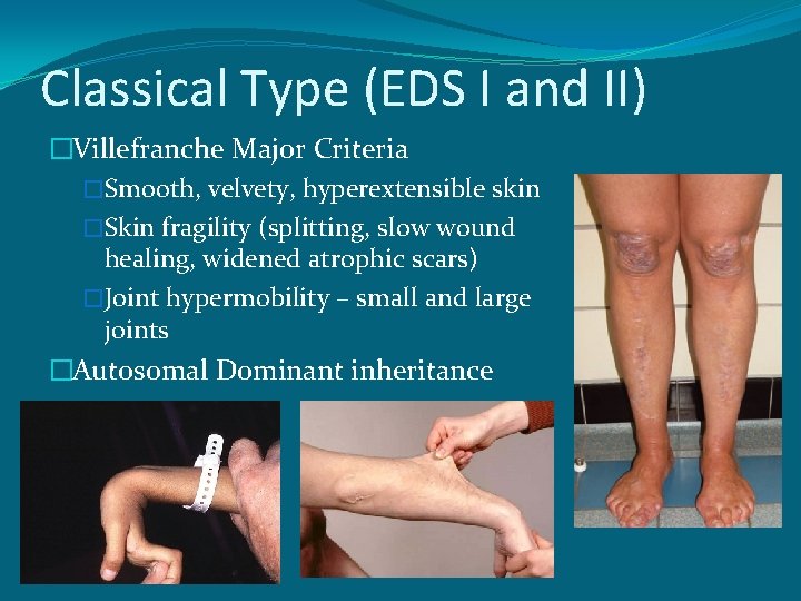 Classical Type (EDS I and II) �Villefranche Major Criteria �Smooth, velvety, hyperextensible skin �Skin