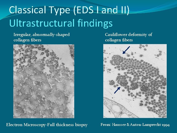Classical Type (EDS I and II) Ultrastructural findings Irregular, abnormally-shaped collagen fibers Electron Microscopy-Full