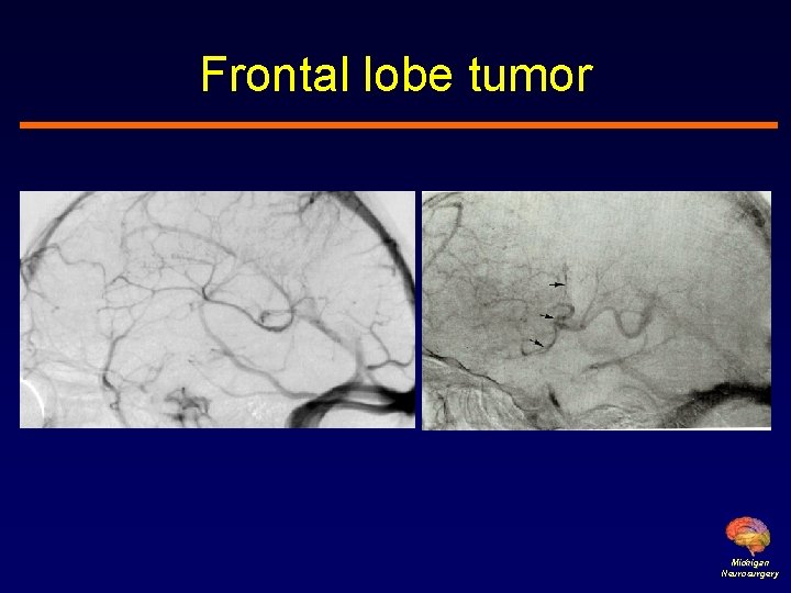 Frontal lobe tumor Michigan Neurosurgery 