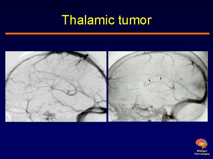 Thalamic tumor Michigan Neurosurgery 