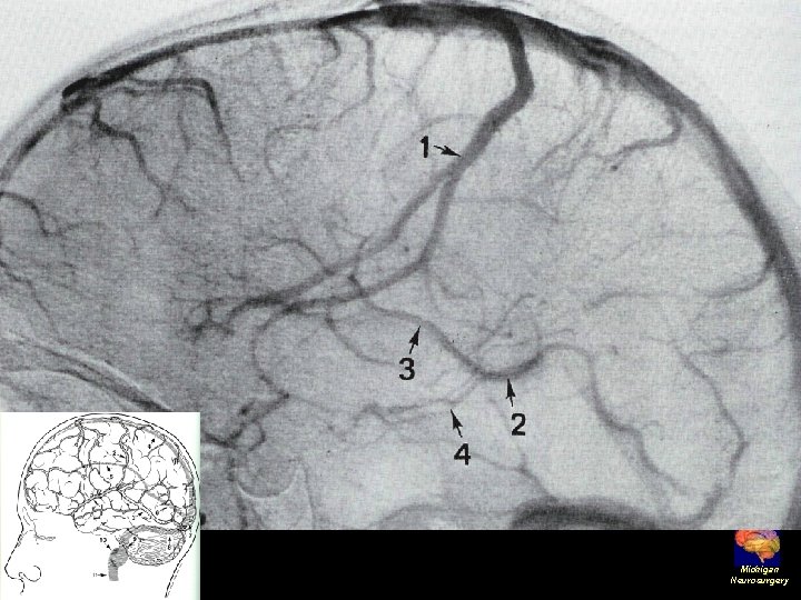 Michigan Neurosurgery 