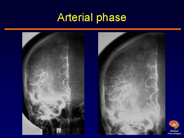 Arterial phase Michigan Neurosurgery 