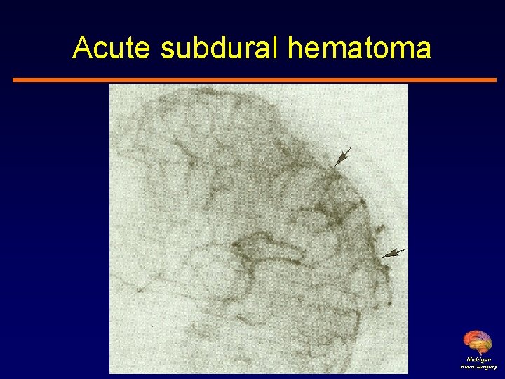 Acute subdural hematoma Michigan Neurosurgery 
