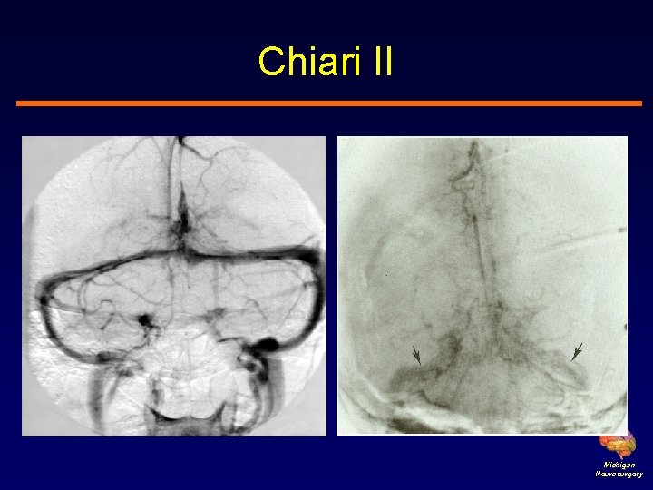 Chiari II Michigan Neurosurgery 