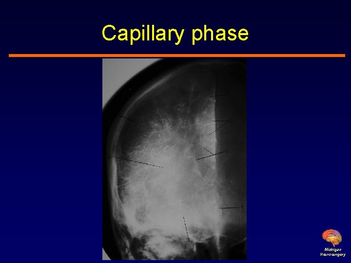 Capillary phase Michigan Neurosurgery 