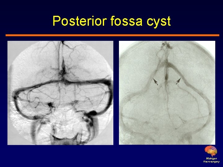 Posterior fossa cyst Michigan Neurosurgery 