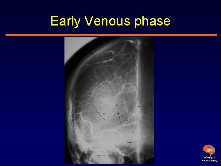 Early Venous phase Michigan Neurosurgery 