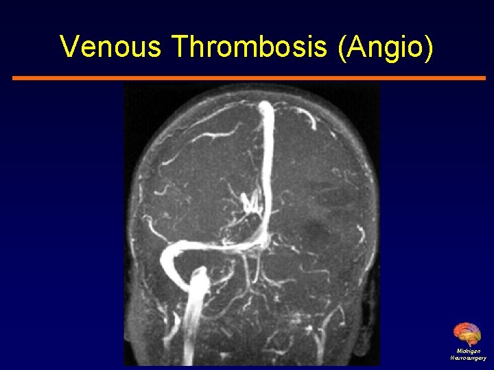 Venous Thrombosis (Angio) Michigan Neurosurgery 