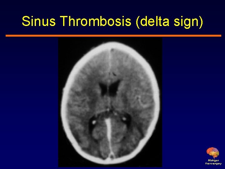 Sinus Thrombosis (delta sign) Michigan Neurosurgery 