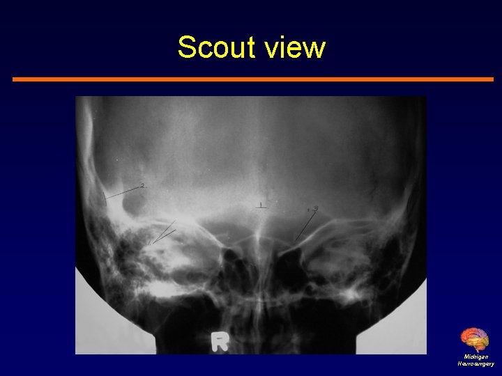 Scout view Michigan Neurosurgery 