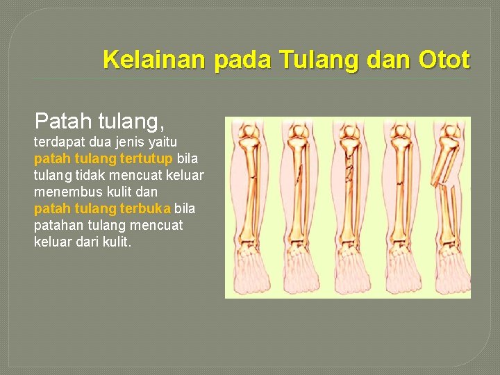 Kelainan pada Tulang dan Otot Patah tulang, terdapat dua jenis yaitu patah tulang tertutup