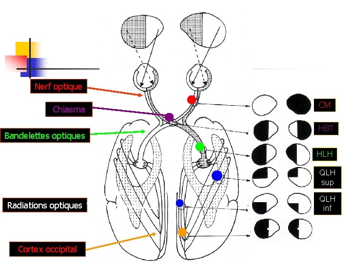 Nerf optique Chiasma Bandelettes optiques CM HBT HLH QLH sup Radiations optiques Cortex occipital