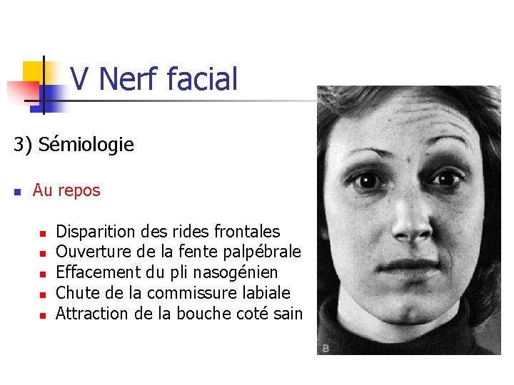 V Nerf facial 3) Sémiologie n Au repos n n n Disparition des rides