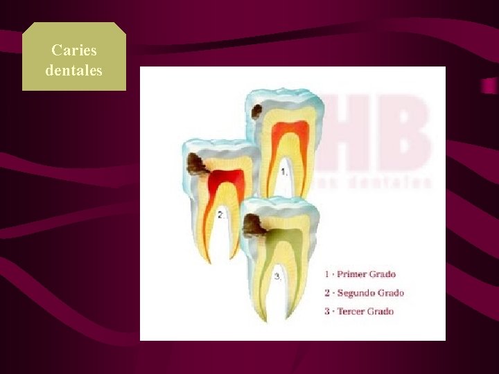 Caries dentales 