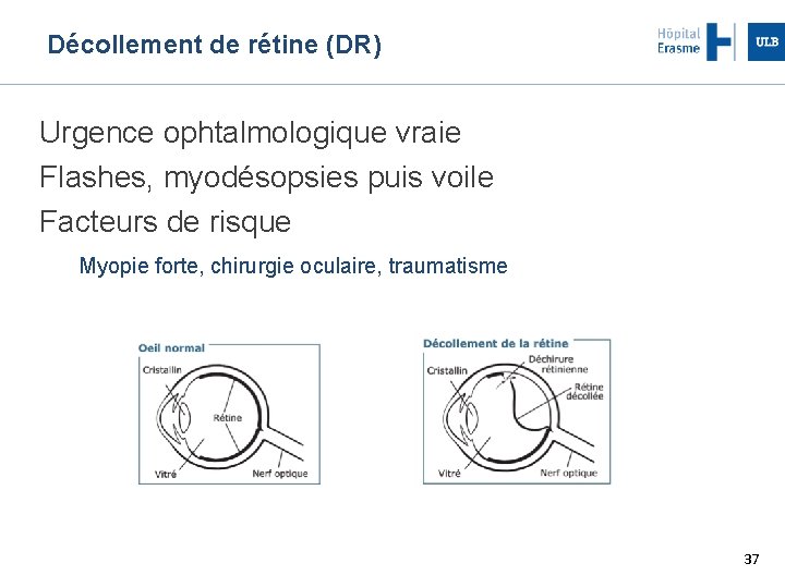 Décollement de rétine (DR) Urgence ophtalmologique vraie Flashes, myodésopsies puis voile Facteurs de risque