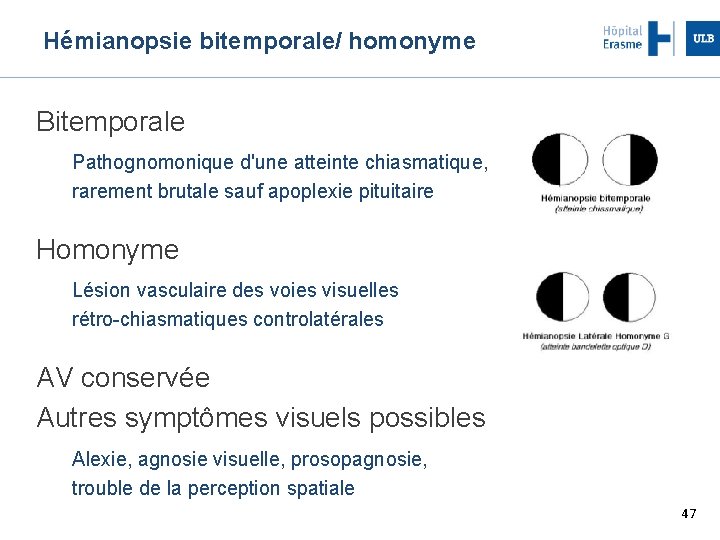 Hémianopsie bitemporale/ homonyme Bitemporale Pathognomonique d'une atteinte chiasmatique, rarement brutale sauf apoplexie pituitaire Homonyme