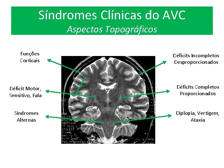Síndromes Clínicas do AVC Aspectos Topográficos Funções Corticais Déficits Incompletos Desproporcionados Déficit Motor, Sensitivo,