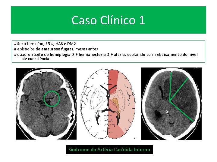 Caso Clínico 1 # Sexo feminino, 65 a, HAS e DM 2 # episódios