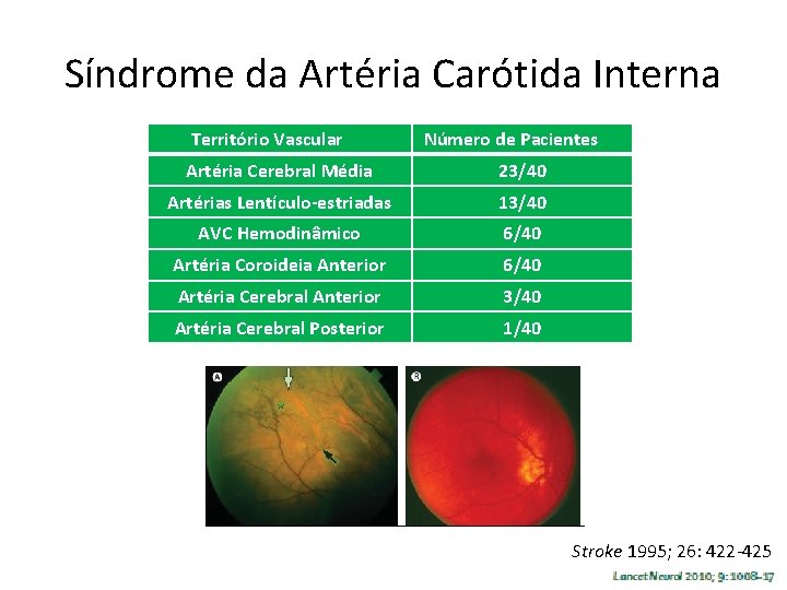 Síndrome da Artéria Carótida Interna Território Vascular Número de Pacientes Artéria Cerebral Média 23/40