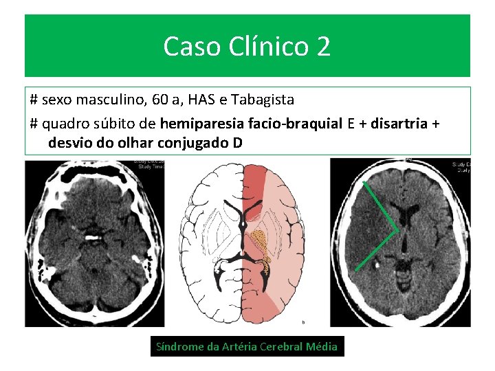 Caso Clínico 2 # sexo masculino, 60 a, HAS e Tabagista # quadro súbito