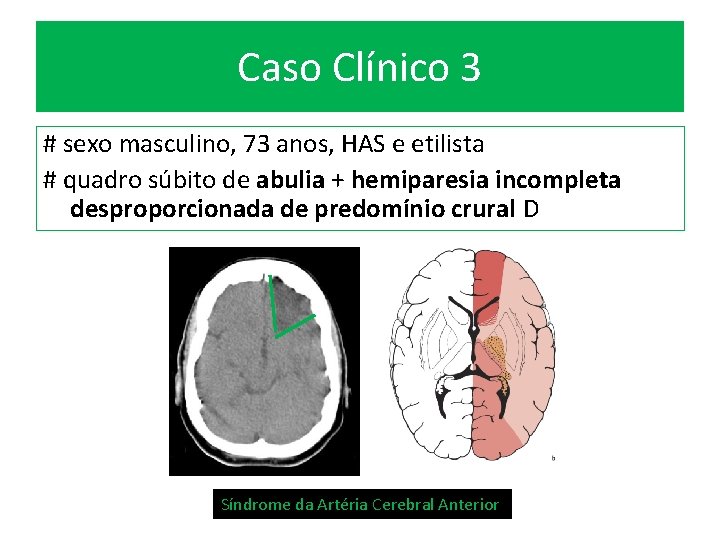 Caso Clínico 3 # sexo masculino, 73 anos, HAS e etilista # quadro súbito