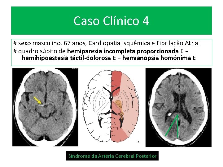 Caso Clínico 4 # sexo masculino, 67 anos, Cardiopatia Isquêmica e Fibrilação Atrial #