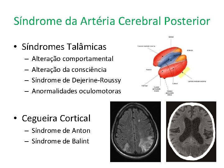 Síndrome da Artéria Cerebral Posterior • Síndromes Talâmicas – – Alteração comportamental Alteração da